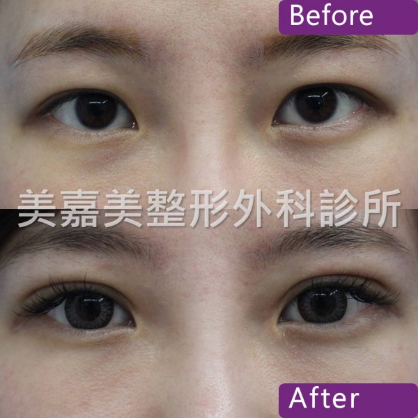 雙眼皮手術案例
