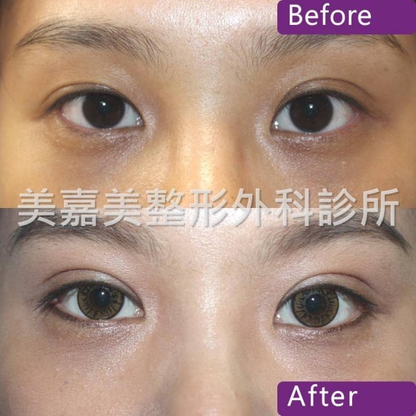 雙眼皮手術案例