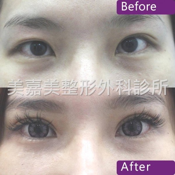 雙眼皮手術案例