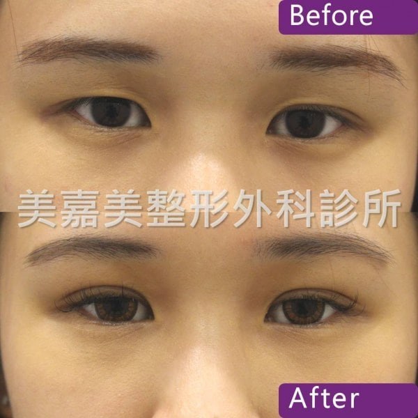 雙眼皮手術案例