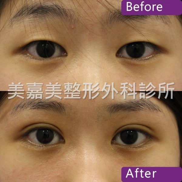 雙眼皮手術案例