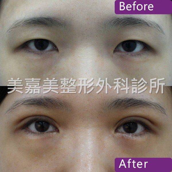雙眼皮手術案例