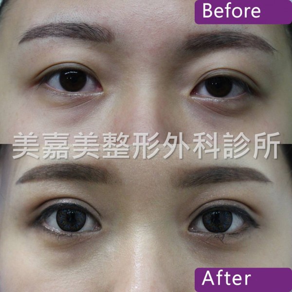 雙眼皮手術案例