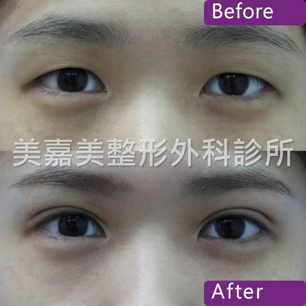 雙眼皮手術案例