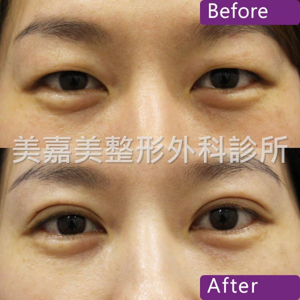 雙眼皮手術案例