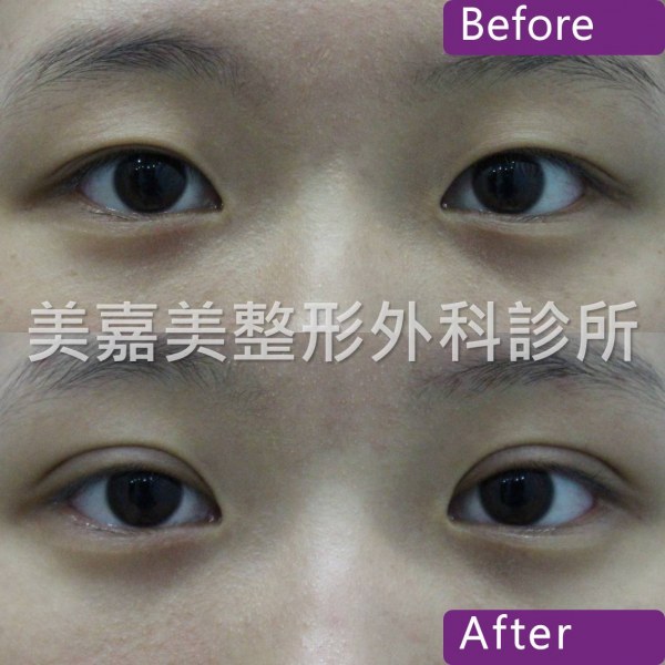 雙眼皮手術案例