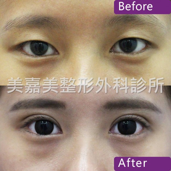 雙眼皮手術案例