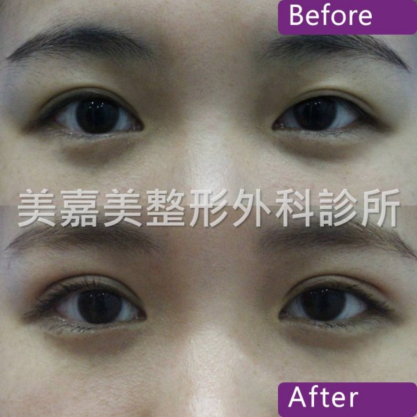 雙眼皮手術案例
