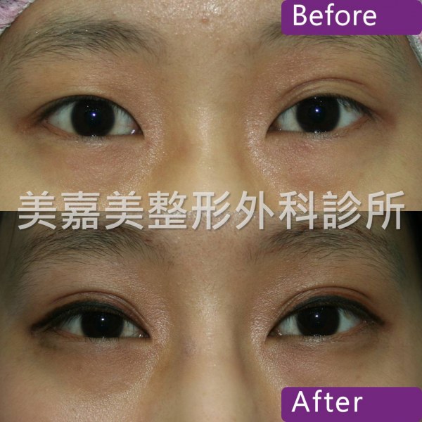 雙眼皮手術案例