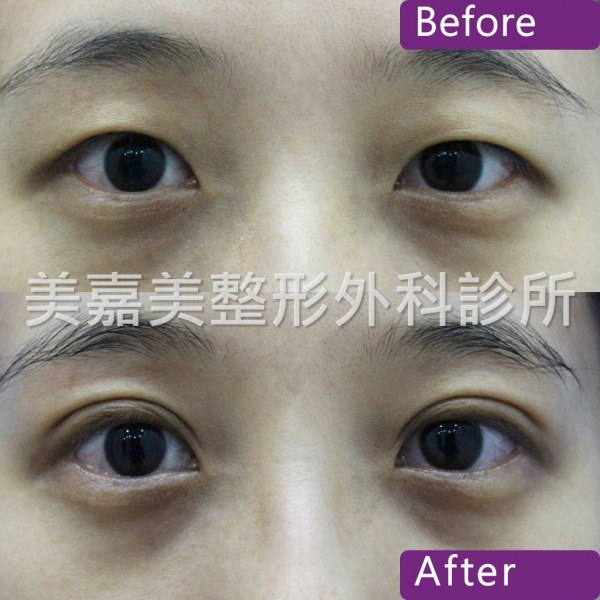 雙眼皮手術案例