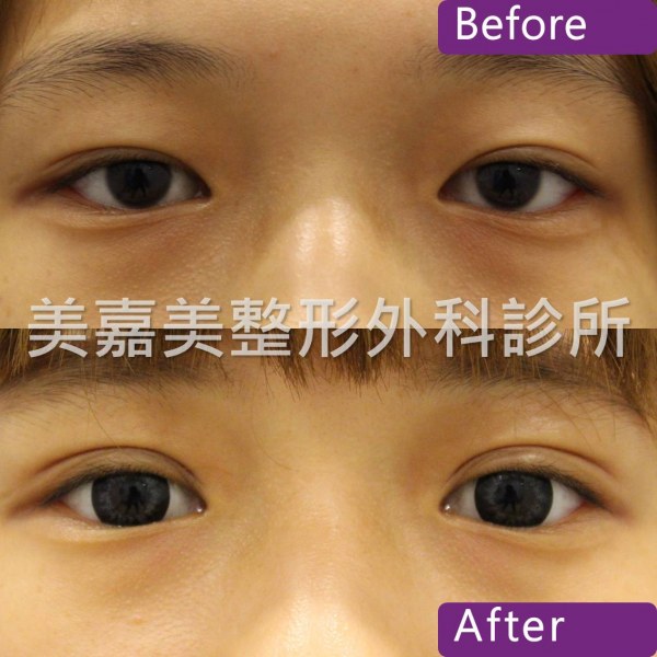 雙眼皮手術案例
