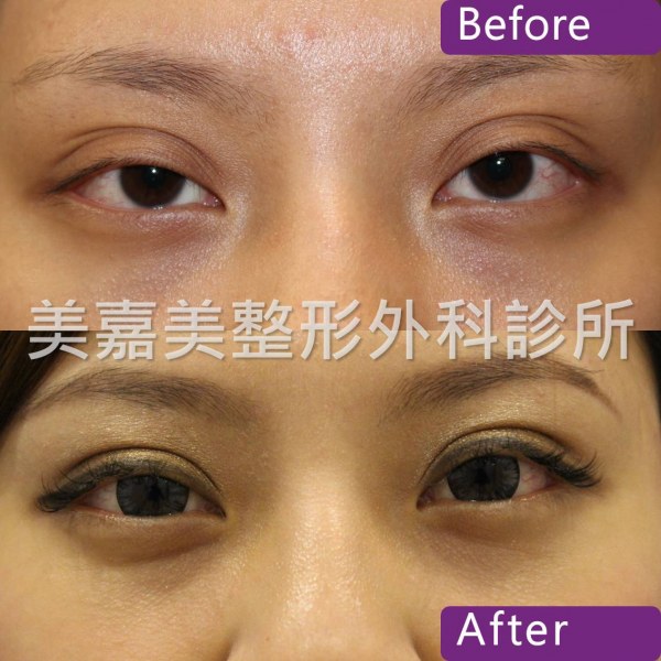 雙眼皮手術案例