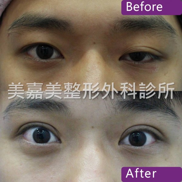 雙眼皮手術案例