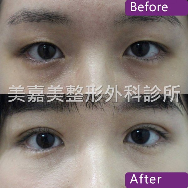 雙眼皮手術案例