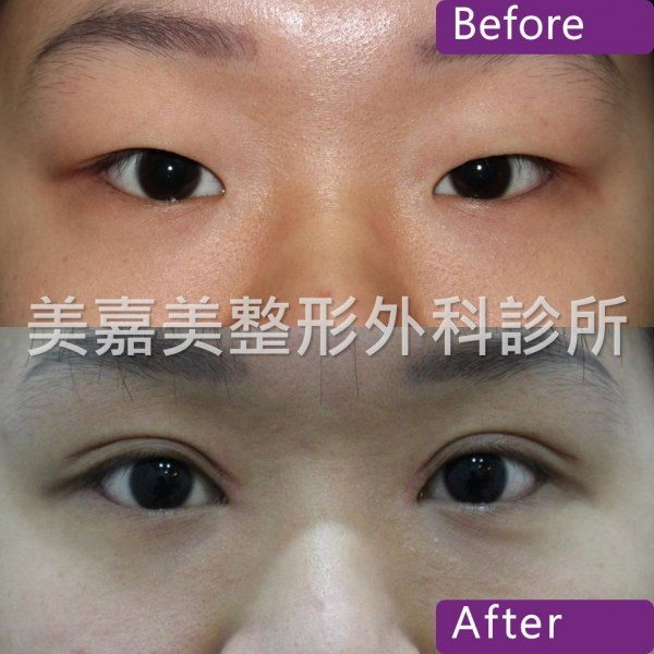 雙眼皮手術案例
