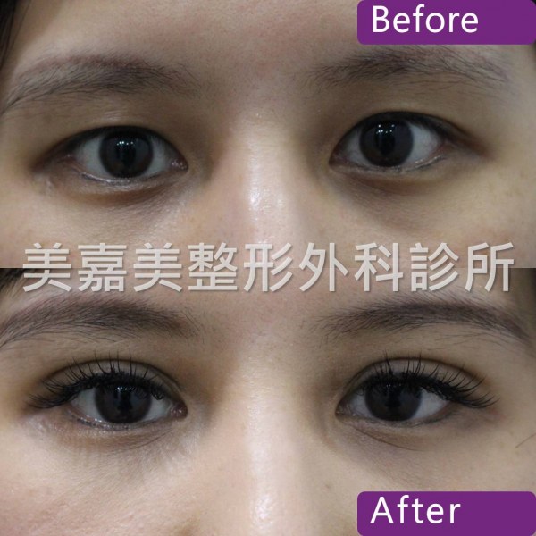 雙眼皮手術案例