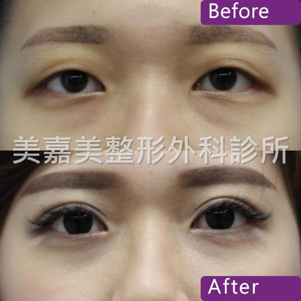 雙眼皮手術案例