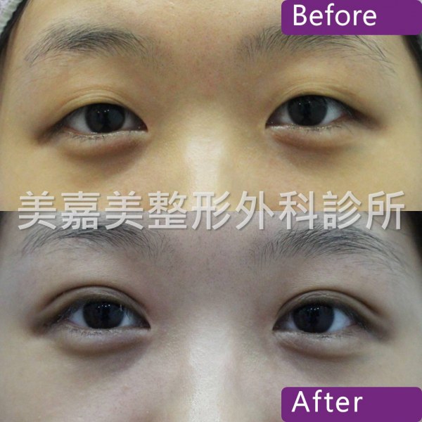 雙眼皮手術案例