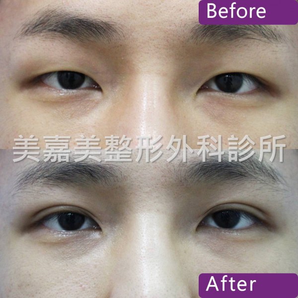 雙眼皮手術案例