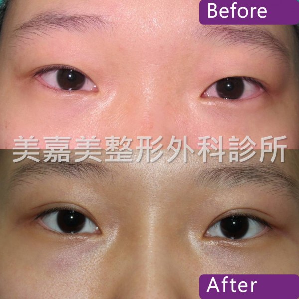雙眼皮手術案例