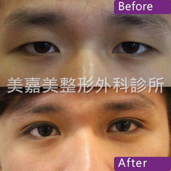 雙眼皮手術案例