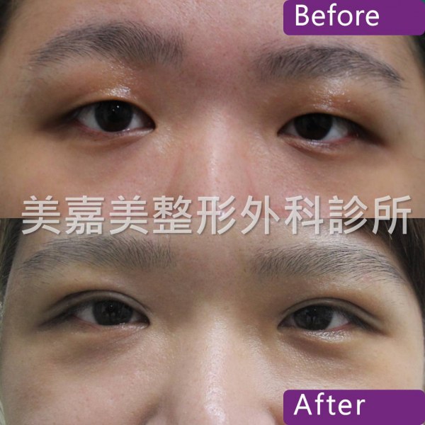 雙眼皮手術案例