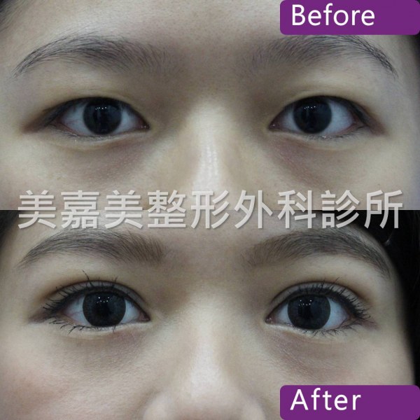 雙眼皮手術案例