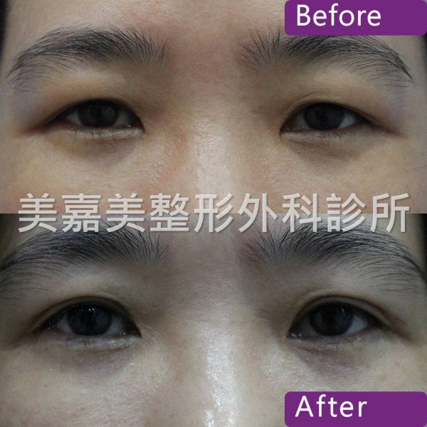 雙眼皮手術案例