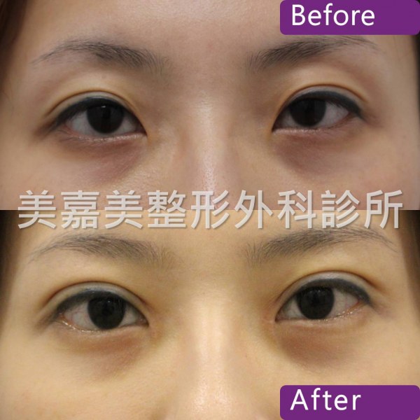 雙眼皮手術案例