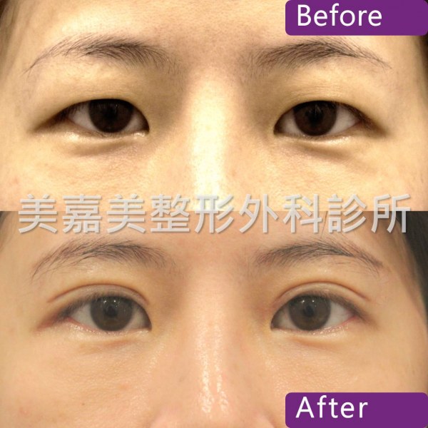 雙眼皮手術案例