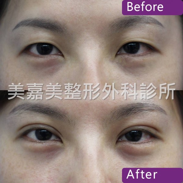 雙眼皮手術案例
