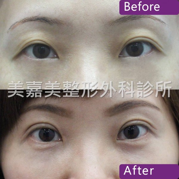 雙眼皮手術案例