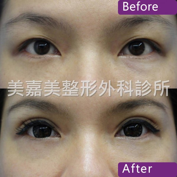 雙眼皮手術案例