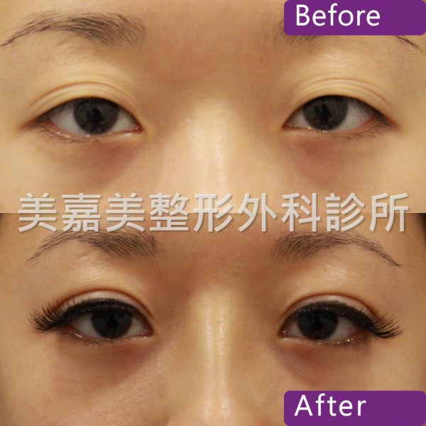 雙眼皮手術案例