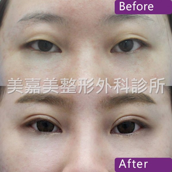雙眼皮手術案例
