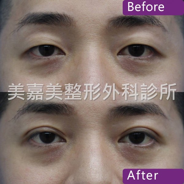 雙眼皮手術案例