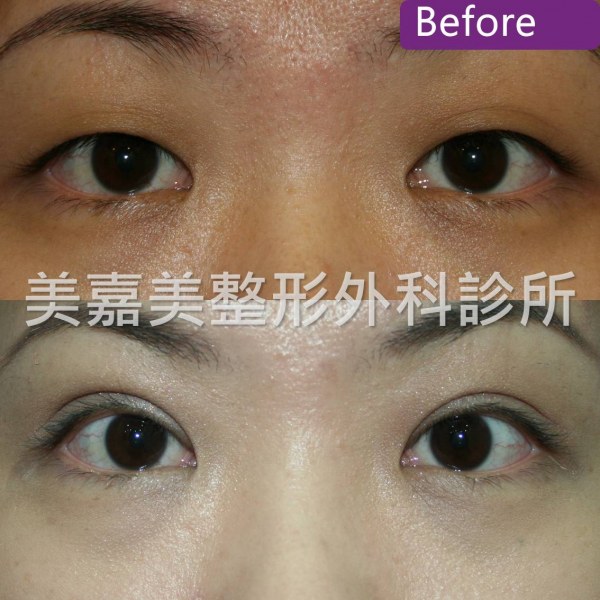 雙眼皮手術案例