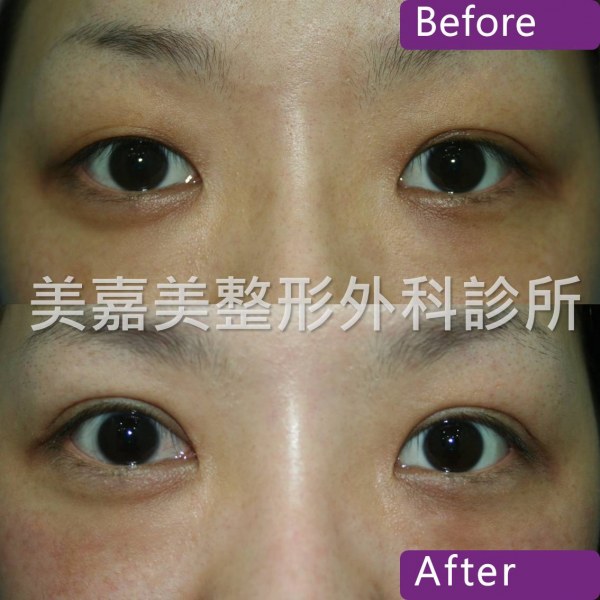 雙眼皮手術案例