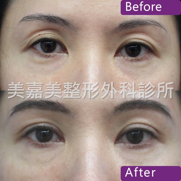 雙眼皮手術案例