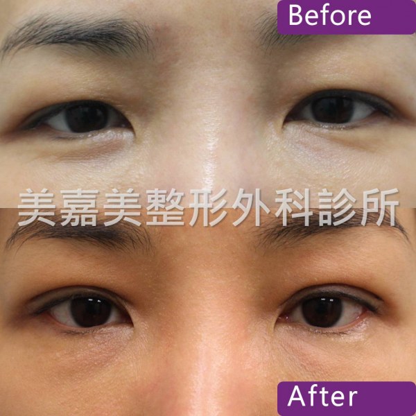雙眼皮手術案例