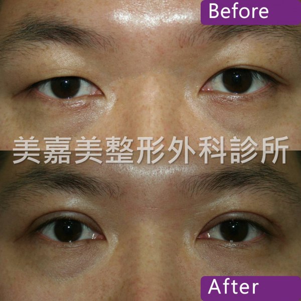 雙眼皮手術案例