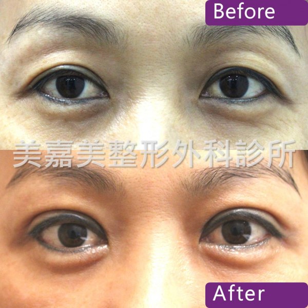 雙眼皮手術案例