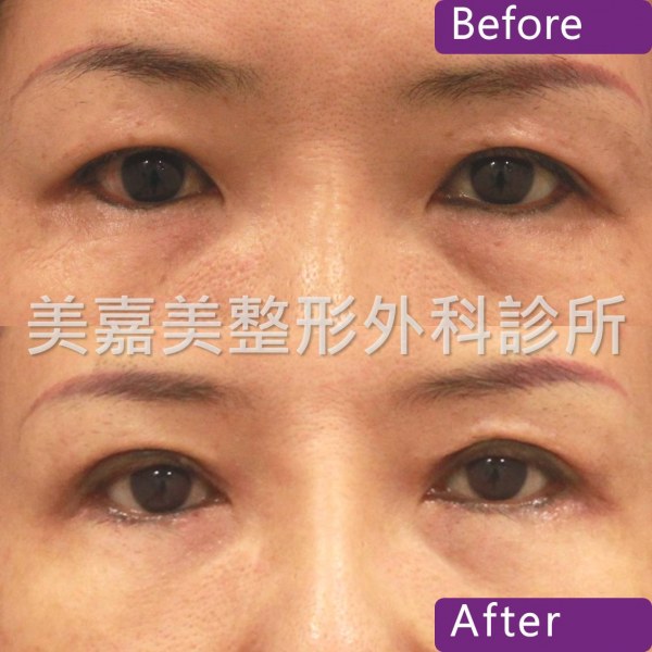 雙眼皮手術案例