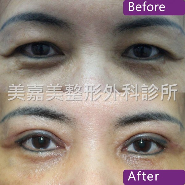 雙眼皮手術案例