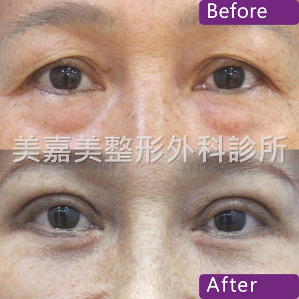 雙眼皮手術案例