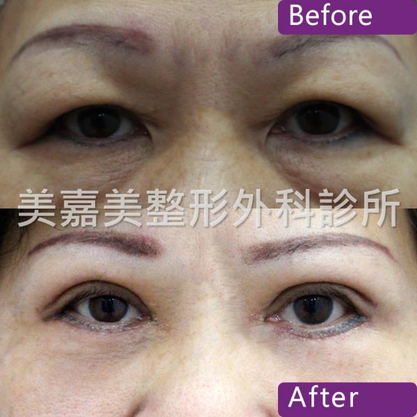 雙眼皮手術案例