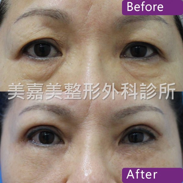 雙眼皮手術案例