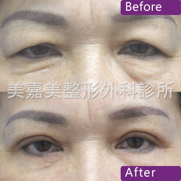 雙眼皮手術案例