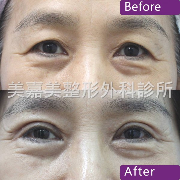 雙眼皮手術案例