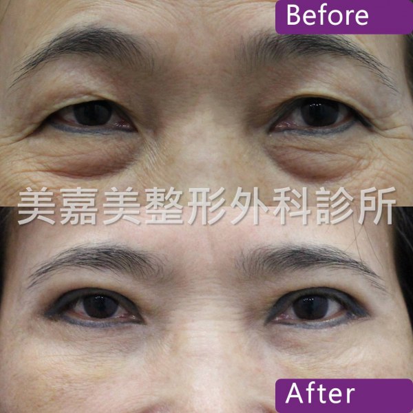 雙眼皮手術案例
